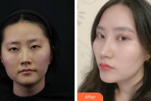 宜春學(xué)院整形美容醫(yī)院白承根整形價格表附切開雙眼皮案例展示