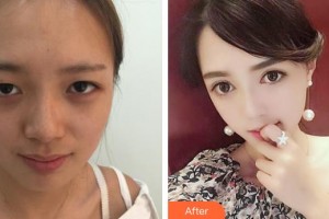 宜春學(xué)院整形美容醫(yī)院易院玲整形價格表附切開雙眼皮案例展示