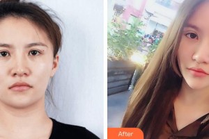 宜春華美醫(yī)療美容醫(yī)院王明華整形價格表附埋線雙眼皮案例展示