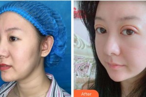 宜春美萊醫(yī)療美容門診部黃治林整形價格表附眼部綜合案例展示