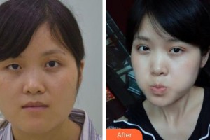 宜春學(xué)院整形美容醫(yī)院彭芳麗整形價格表附切開雙眼皮案例展示