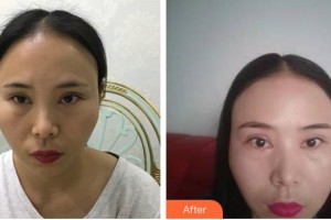 宜春學(xué)院整形美容醫(yī)院張其亮整形價格表附開外眼角案例展示