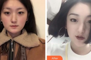 宜春愛爾眼科醫(yī)院張忠勝整形價格表附定點(diǎn)雙眼皮案例展示