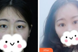 宜春愛爾眼科醫(yī)院周愛云整形價(jià)格表附切開雙眼皮案例展示
