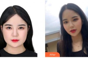 撫州美萊爾醫(yī)療美容門診部熊德成整形價(jià)格表附眼部綜合案例展示