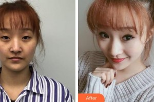 上饒尚美醫(yī)療美容門診部張維華整形價(jià)格表附眼部綜合案例展示