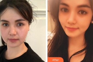 上饒尚美醫(yī)療美容門診部江嵐整形價(jià)格表附埋線提升案例展示