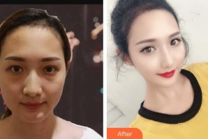 上饒德爾美客醫(yī)療美容門診部程梓寧整形價(jià)格表附射頻緊膚案例展示