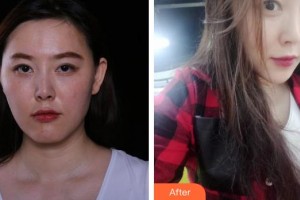 上饒榮美醫(yī)療美容門診部陶小風(fēng)整形價(jià)格表附埋線提升案例展示