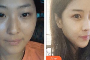 上饒雙博星范醫(yī)療美容門診部毛禹整形價(jià)格表附埋線提升案例展示