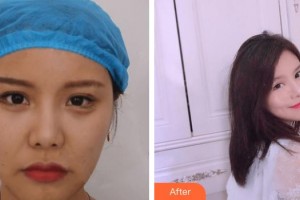 上饒榮美醫(yī)療美容門診部周麗艷整形價(jià)格表附埋線提升案例展示