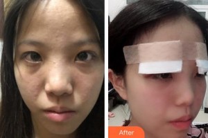 上饒愛爾眼科醫(yī)院羅建華整形價(jià)格表附眼部綜合案例展示