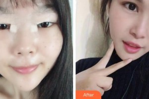 上饒愛爾眼科醫(yī)院蔣道源整形價(jià)格表附切開雙眼皮案例展示