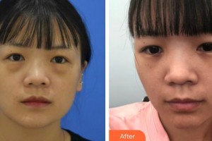 上饒愛爾眼科醫(yī)院陳勝整形價(jià)格表附激光去眼袋案例展示