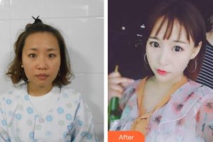 上饒愛爾眼科醫(yī)院徐雅萍整形價(jià)格表附眼部綜合案例展示