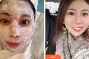 上饒愛爾眼科醫(yī)院錢進(jìn)整形價(jià)格表附眼部綜合案例展示