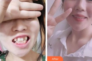 上饒維樂陽(yáng)光口腔門診部徐奐整形價(jià)格表附金屬托槽矯正案例展示