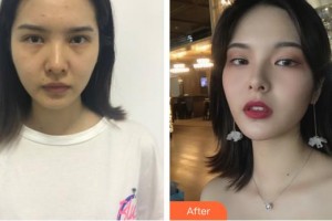 平頂山藝美醫(yī)療美容醫(yī)院白勝萬(wàn)整形價(jià)格表附鼻部綜合案例展示