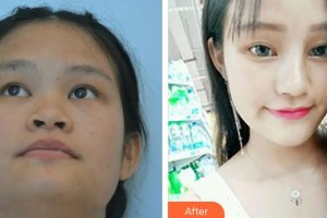 平頂山星美醫(yī)療美容門診部張海明整形價(jià)格表附鼻部綜合案例展示