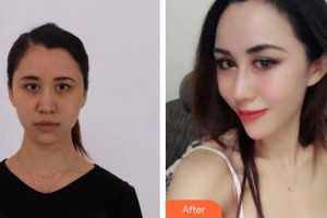 平頂山藝美醫(yī)療美容醫(yī)院楊曉順整形價(jià)格表附鼻部綜合案例展示