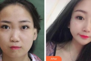 平頂山藝美醫(yī)療美容醫(yī)院王占良整形價(jià)格表附鼻部綜合案例展示