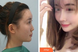 平頂山藝美醫(yī)療美容醫(yī)院于亮整形價(jià)格表附肋軟骨隆鼻案例展示