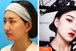 平頂山藝美醫(yī)療美容醫(yī)院孫召琪整形價(jià)格表附鼻骨矯正案例展示