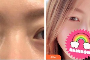 新疆威茲曼整形外科醫(yī)院馬艷麗整形價格表附內(nèi)切祛眼袋案例展示