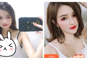 烏魯木齊王姣醫(yī)療美容診所王蛟整形價格表附耳軟骨復(fù)合隆鼻案例展示