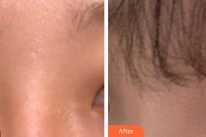 烏魯木齊藥業(yè)集團(tuán)附屬醫(yī)院毛發(fā)種植科肖振鋒整形價格表附眼部綜合案例展示