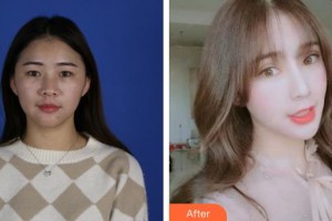 烏魯木齊普瑞眼科醫(yī)院裴莉娜整形價格表附切開雙眼皮案例展示