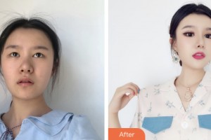 昆山博愛醫(yī)院整形美容中心林華整形價(jià)格表附眼部綜合案例展示