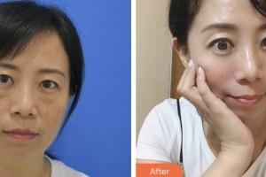 昆山百達(dá)麗醫(yī)療美容門診部沈軍整形價(jià)格表附激光去眼袋案例展示