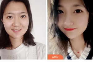 昆山百達(dá)麗醫(yī)療美容門診部楊宇光整形價(jià)格表附光子嫩膚案例展示