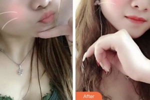 昆山第一人民醫(yī)院燒傷整形科肖貴喜整形價(jià)格表附紅藍(lán)光祛痘案例展示