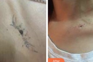 昆山鉑特麗醫(yī)療美容門診部趙新星整形價(jià)格表附激光去紋身案例展示