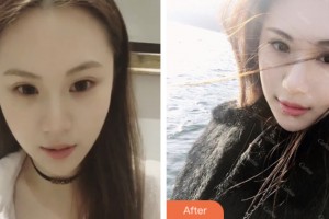 昆山魅萊醫(yī)療美容門診部陳軍芹整形價(jià)格表附激光美膚激光案例展示