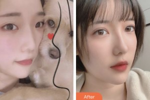 昆山魅萊醫(yī)療美容門診部金志揚(yáng)整形價(jià)格表附切開雙眼皮案例展示