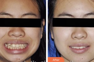 昆山萌牙客口腔門診部王雨生整形價(jià)格表附隱形托槽矯正案例展示