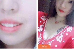 昆山萌牙客口腔門診部沈衛(wèi)整形價(jià)格表附牙齒隱形矯正案例展示