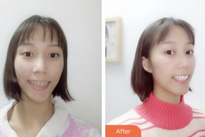 昆山愛爾眼科醫(yī)院周世芳整形價(jià)格表附口腔美白牙齒案例展示