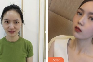 昆山愛爾眼科醫(yī)院孟亞麗整形價(jià)格表附切開雙眼皮案例展示