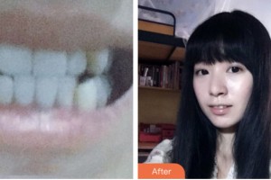 昆山同濟(jì)口腔醫(yī)院胡宏娥整形價(jià)格表附金屬托槽矯正案例展示