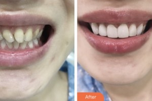 昆山同濟(jì)口腔醫(yī)院劉努整形價(jià)格表附牙貼面案例展示