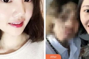 昆山禾豐口腔醫(yī)院張明進(jìn)整形價(jià)格表附牙齒隱形矯正案例展示