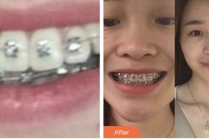 昆山同濟(jì)口腔醫(yī)院顧圣祖整形價(jià)格表附金屬托槽矯正案例展示