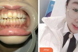 昆山禾豐口腔醫(yī)院周昌浩整形價(jià)格表附美白貼片案例展示