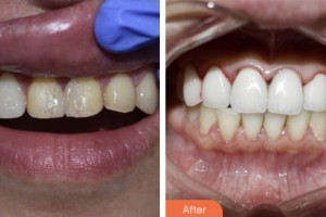 昆山禾豐口腔醫(yī)院丁載雄整形價(jià)格表附牙貼面案例展示