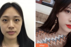 齊齊哈爾千百度整形美容醫(yī)院張俠整形價(jià)格表附眼部綜合案例展示