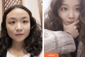 齊齊哈爾千百度整形美容醫(yī)院佟彤整形價(jià)格表附切開雙眼皮案例展示